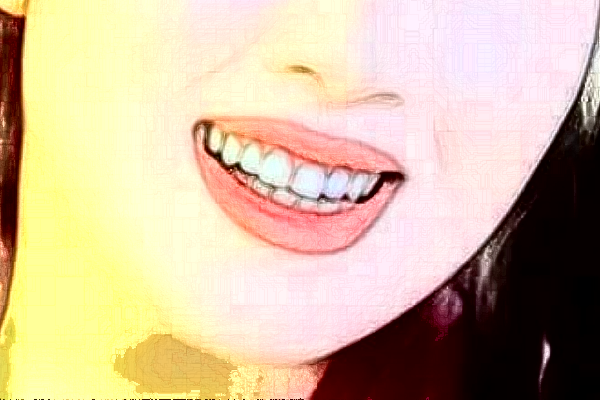 長沙科爾雅口腔醫(yī)院樹脂補(bǔ)牙價(jià)格多少?整形日記全過程分享