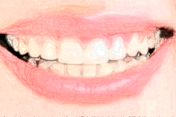 2024山西省人民醫(yī)院烤瓷牙費(fèi)用多少?整形日記全過(guò)程