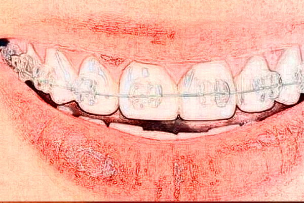 成都新橋口腔醫(yī)院種植牙怎么樣?種植牙品牌選擇