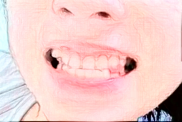 2024成都新橋口腔醫(yī)院矯正牙價格?矯正牙齒的危害