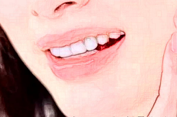 2024鄭州植得口腔醫(yī)院種牙多少錢?種牙好還是鑲牙好