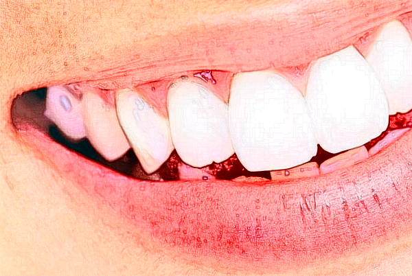 天津南開醫(yī)院成人正畸怎么樣_整形日記分享