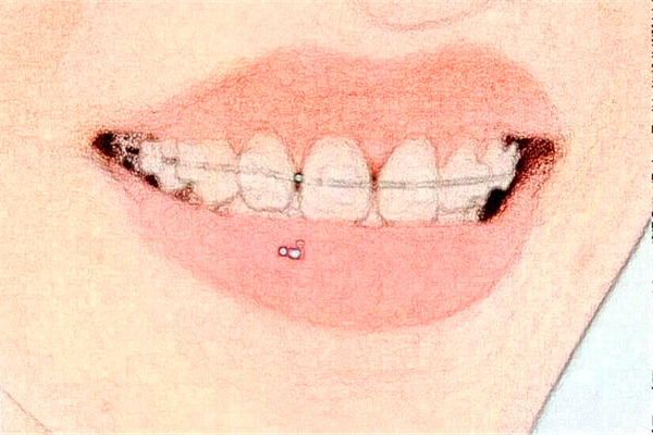 重慶齊美口腔門診部牙齒稀疏價(jià)目表全新發(fā)布!案例反饋