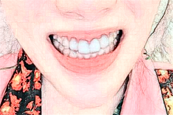 蘇州姑蘇美奧口腔地包天矯正費用多少_真實案例反饋