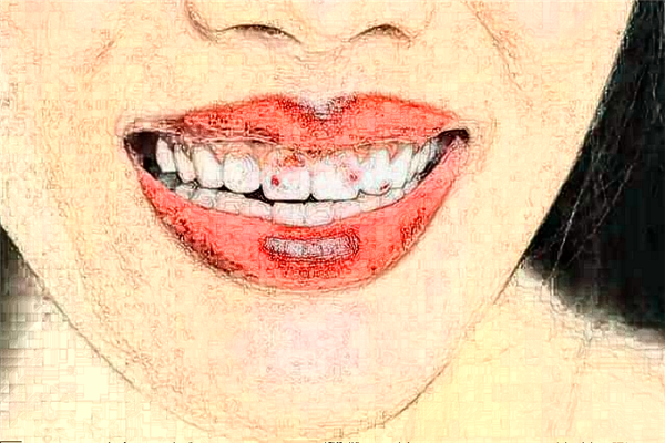 2024蘇州康美美容醫(yī)院瓷貼面怎么樣_整形日記分享