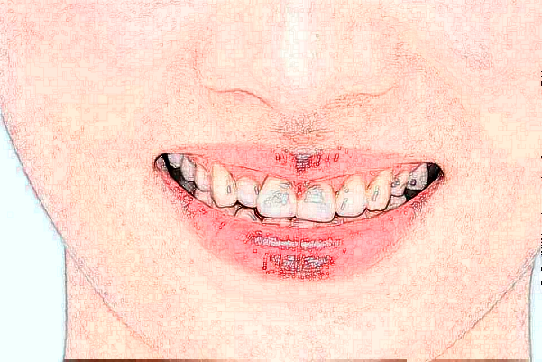 2024中山香山口腔醫(yī)院超聲波洗牙多少錢(qián)?超聲波洗牙的危害