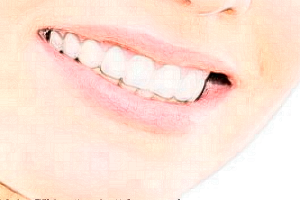 重慶團(tuán)圓口腔醫(yī)院拔智齒怎么樣?拔智齒要花多少錢?