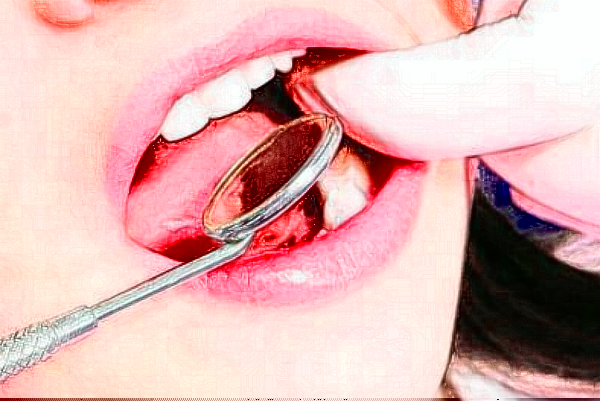 2024中山香山口腔醫(yī)院全瓷牙價(jià)格?全瓷牙會(huì)不會(huì)有后遺癥?