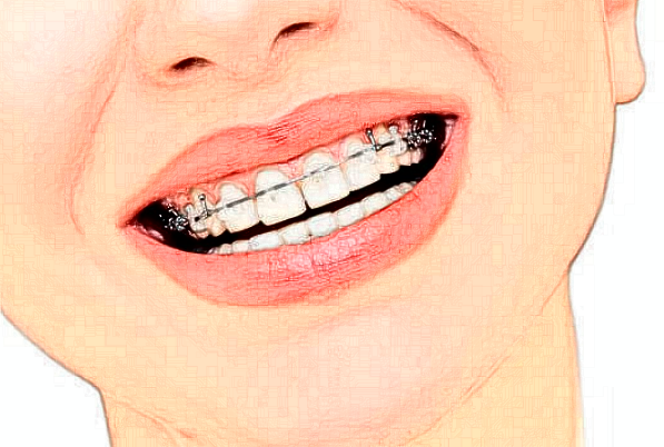 2024北京牙管家口腔診所自鎖托槽矯正怎么樣_專(zhuān)家信息_案例大全欣賞