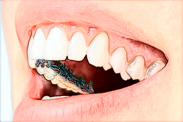 2024鄭州植得口腔醫(yī)院牙齒矯正多少錢?牙齒矯正的醫(yī)生