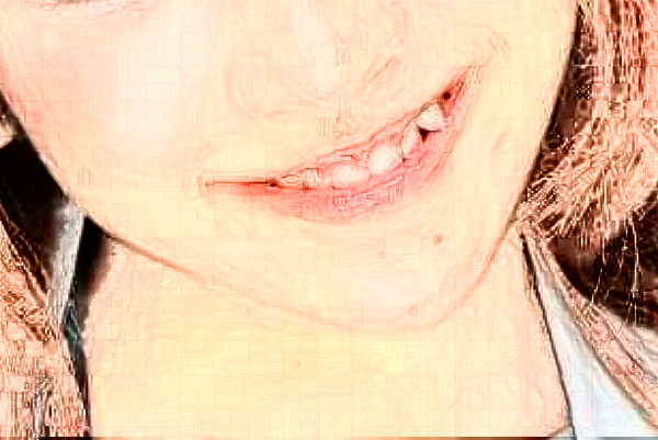 重慶世紀(jì)美奧口腔醫(yī)院種植牙是怎么種的?種植牙的材料