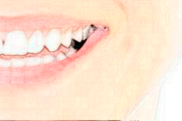 2024福州登特口腔醫(yī)院隱形矯正價格(價目)_案例_