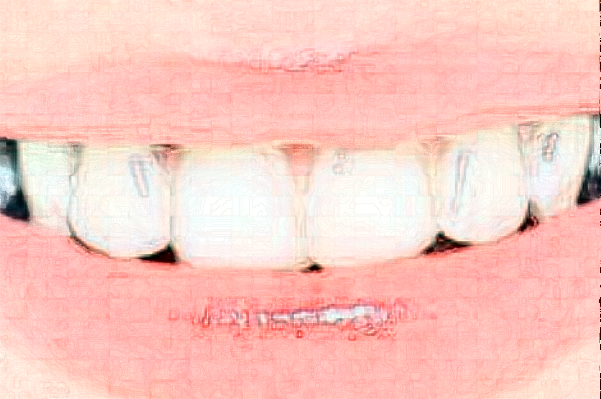 延安牙衛(wèi)士口腔樹(shù)脂補(bǔ)牙價(jià)格(價(jià)目)_案例_