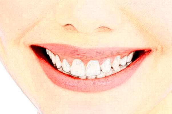 延安牙衛(wèi)士口腔樹(shù)脂補(bǔ)牙價(jià)格(價(jià)目)_案例_