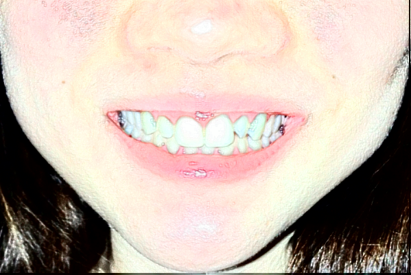 河南美奧口腔醫(yī)院醫(yī)生技術(shù)怎么樣?2024牙齒矯正收費多少