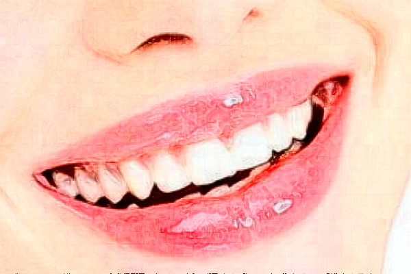 中山香山口腔醫(yī)院烤瓷牙怎么樣?烤瓷牙能用多少年