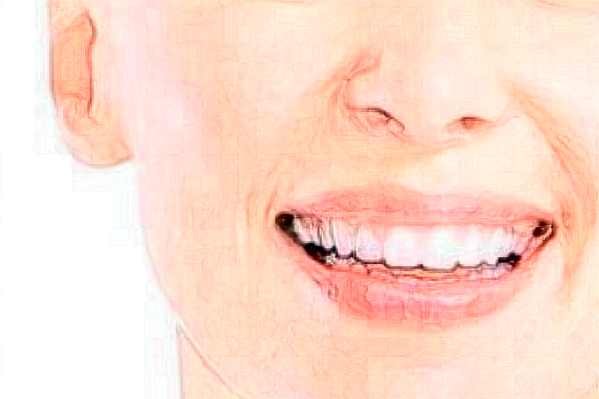 2024成都茁悅口腔半隱形矯正價格表(價目表)怎么樣