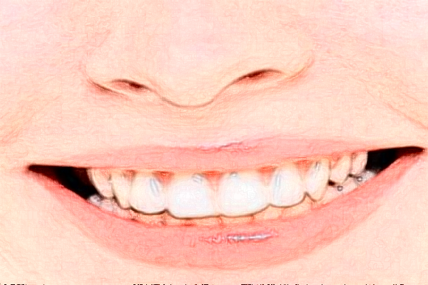 成都圣貝牙科醫(yī)院全口種植價格多少?整形日記全過程分享