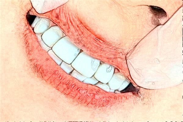 成都茁悅口腔隱形托槽矯正做的好嗎?哪位醫(yī)生做得好