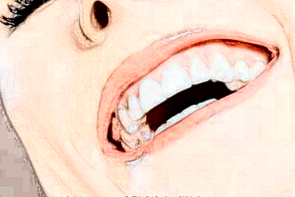 無錫市人民醫(yī)院種植牙怎么樣_案例分享