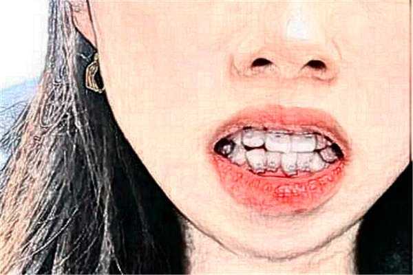 鄭州唯美口腔醫(yī)院種植牙價格多少?整形日記全過程分享