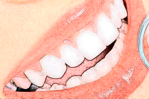 2024延安牙衛(wèi)士口腔隱形矯正價目表(價格表)_口碑怎么樣