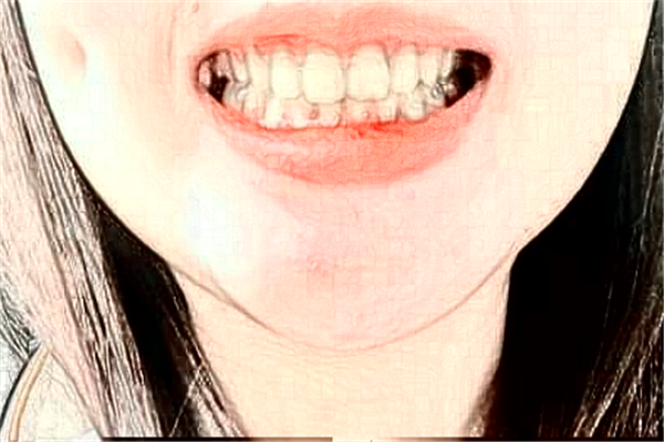 杭州雅萊口腔烤瓷牙貴不貴?案例緊跟一覽!