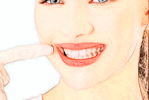 2024河南美奧口腔醫(yī)院瓷貼面價格?瓷貼面有哪幾種