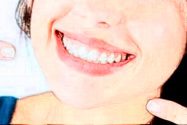 2024武漢德韓口腔醫(yī)療全瓷冠多少錢(qián)?全瓷冠和全鋯冠的區(qū)別