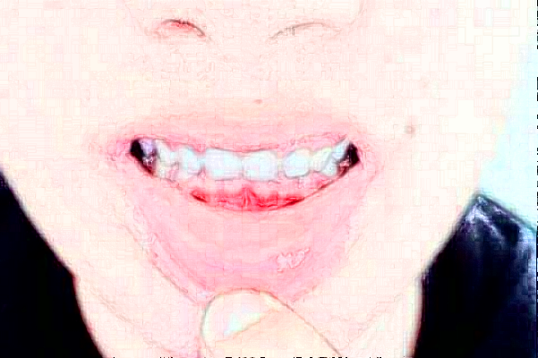 重慶團(tuán)圓口腔醫(yī)院正畸到底好不好?2024正畸牙齒的費(fèi)用