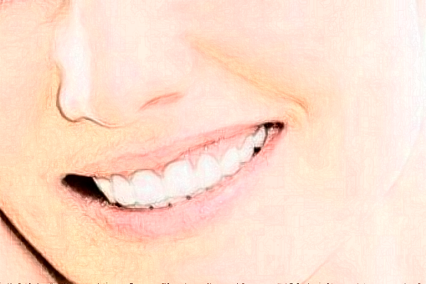 2024深圳樂(lè)莎莎口腔醫(yī)院拔牙費(fèi)用?拔牙后注意事項(xiàng)