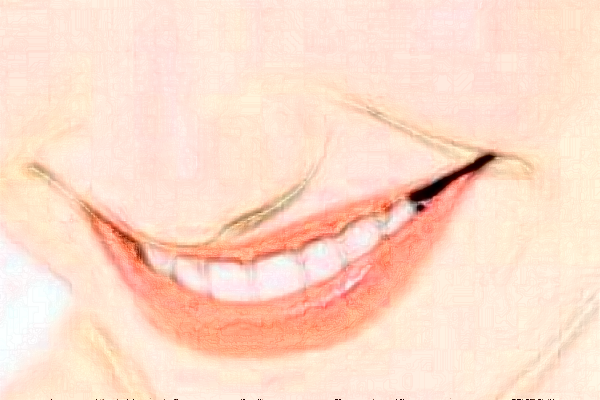 2024深圳樂(lè)莎莎口腔醫(yī)院拔牙費(fèi)用?拔牙后注意事項(xiàng)