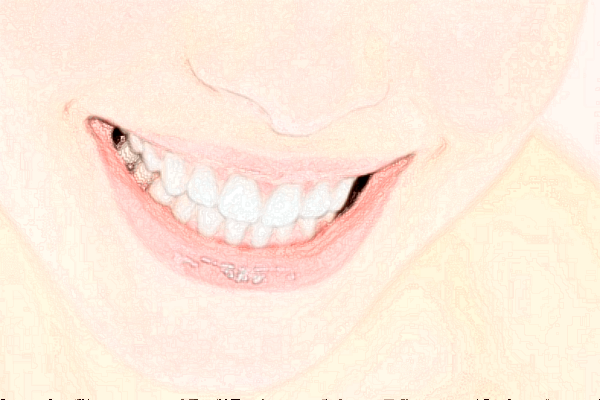 2024深圳樂(lè)莎莎口腔醫(yī)院補(bǔ)牙價(jià)格?補(bǔ)牙痛不痛?