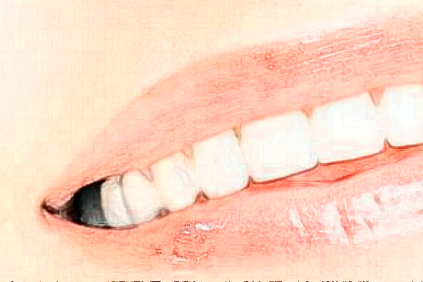 成都圣貝牙科醫(yī)院牙列擁擠矯正怎么樣|醫(yī)生介紹|價格收費