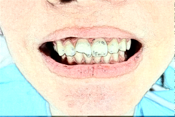 2024福州美橙口腔拔牙怎么樣?哪個(gè)醫(yī)生好+價(jià)格