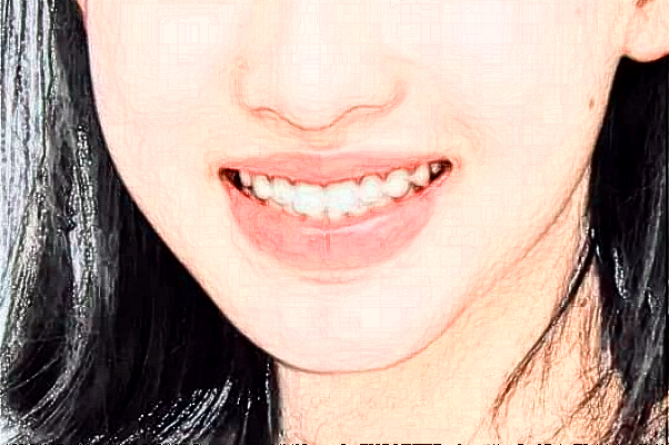 2024義烏傅氏口腔門診部超聲波洗牙價(jià)格?超聲波洗牙案例