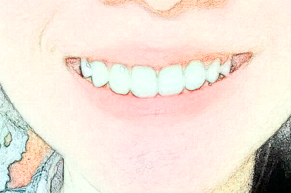 武漢德韓口腔醫(yī)院種植牙哪個(gè)好?種植牙過(guò)程會(huì)很痛嗎