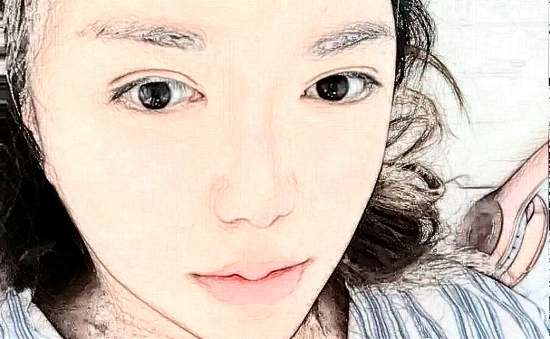 鄭州華領(lǐng)醫(yī)療美容醫(yī)院除皺三個(gè)月術(shù)后案例反饋(效果怎么樣?技術(shù)評(píng)價(jià))