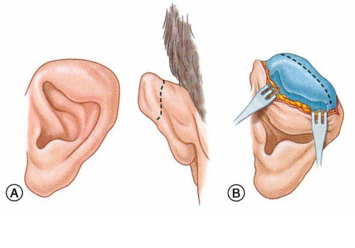 寧波整形外科醫(yī)院杯狀耳整形怎么樣?價格?術(shù)后120天案例&技術(shù)級別