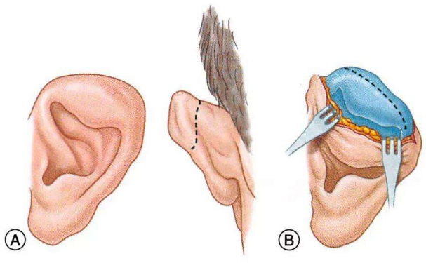鄭州集美整形醫(yī)院耳朵矯正技術(shù)怎么樣?費(fèi)用明細(xì)?案例反饋
