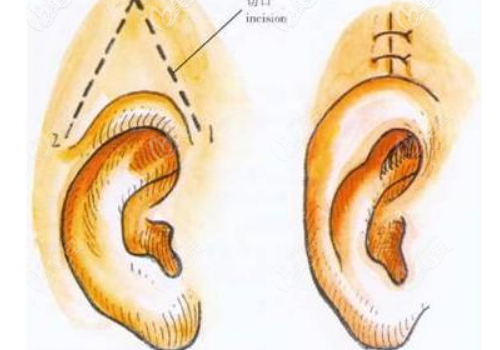 威海孫漫醫(yī)療美容診所杯狀耳矯正技術(shù)怎么樣?費(fèi)用標(biāo)準(zhǔn)?術(shù)后半年案例