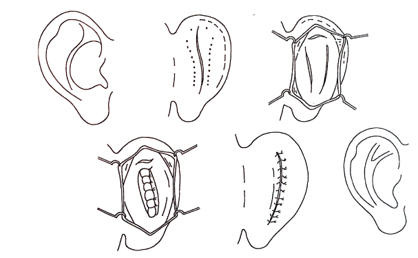 華中科技大學(xué)同濟醫(yī)學(xué)院醫(yī)院杯狀耳矯正術(shù)后三個月案例曝光|技術(shù)能力怎么樣?費用多少