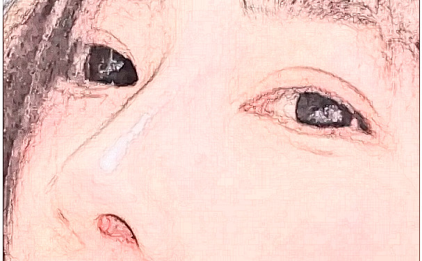 成都煥顏醫(yī)療美容整形醫(yī)院硅膠隆鼻術(shù)后三個(gè)月案例反饋&技術(shù)怎么樣?