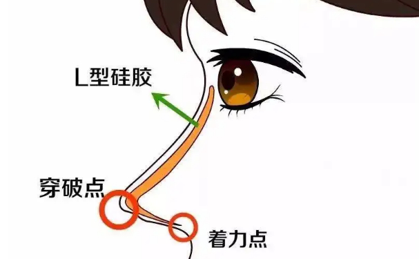 王志富醫(yī)療美容自體隆鼻120天案例點(diǎn)評(píng)&技術(shù)怎么樣?