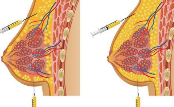 麗港麗格醫(yī)療美容門診部脂肪移植隆胸技術(shù)等級怎么樣?術(shù)后120天案例&價格