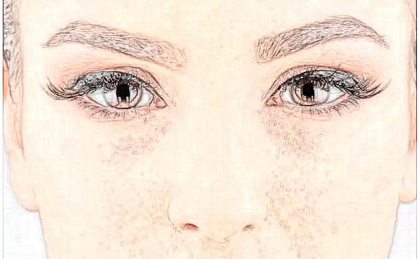 上海薇琳醫(yī)療美容醫(yī)院微創(chuàng)雙眼皮技術(shù)怎么樣?半年案例恢復(fù)過程|報(bào)價(jià)多少