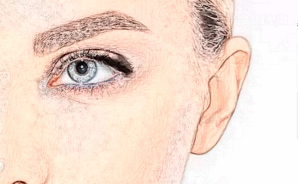 沈陽碧航醫(yī)療診所定點雙眼皮半年術后案例反饋&技術怎么樣?