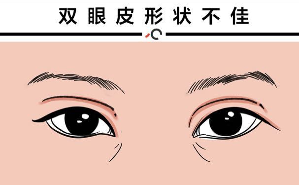 杭州蕭山詮昕醫(yī)療美容門(mén)診部扇形雙眼皮費(fèi)用查詢?技術(shù)評(píng)測(cè)&術(shù)后三個(gè)月案例曝光