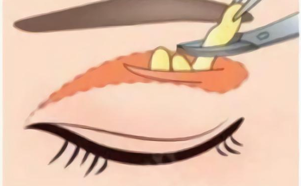 華中科技大學(xué)同濟(jì)醫(yī)學(xué)院醫(yī)院割腫泡眼雙眼皮90天親測(cè)案例全解&報(bào)價(jià)多少?