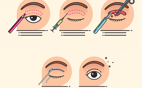 安徽立新整形美容雙眼皮技術怎么樣?價格一覽表?一年術后案例反饋